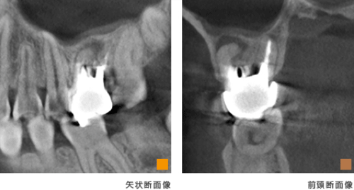 歯科用CT画像