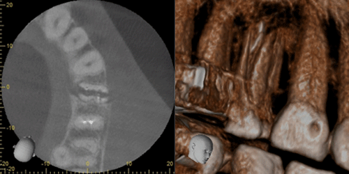 歯科用CT画像